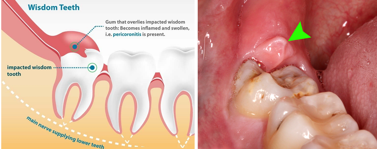 Oral Surgery Wisdom Tooth 38