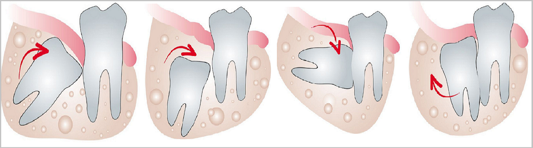 Oral Surgery Wisdom Teeth 91